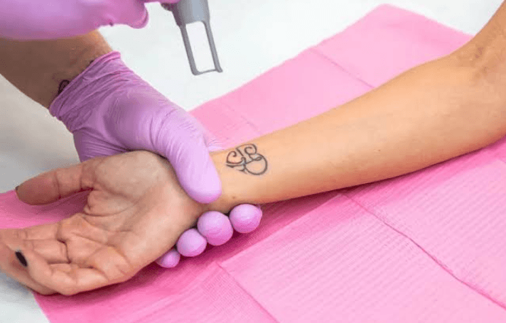 Tattoo Studios Lose Removal Work To Five Avoidable Mistakes